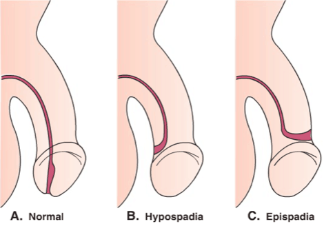 尿道孔不正常，尿道下裂發作