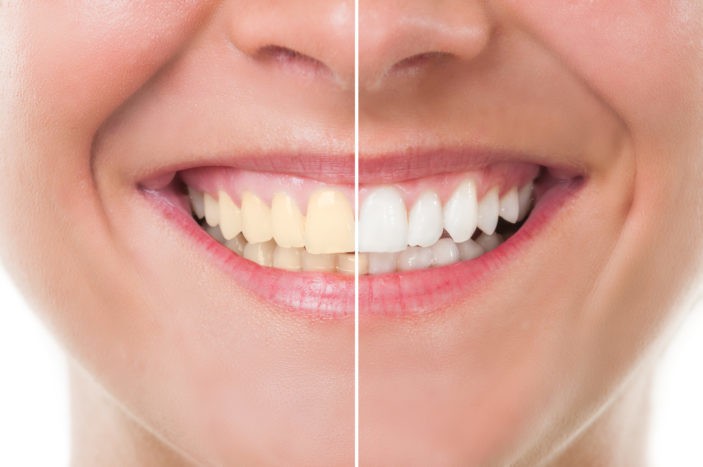 美白牙齒漂白的副作用