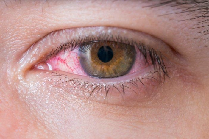 過敏性紅眼結膜炎