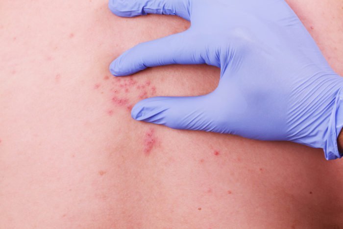 什麼是帶狀皰疹？水痘或天花蛇疼