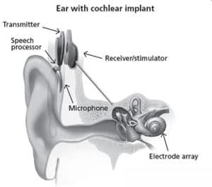 人工耳蝸植入裝置