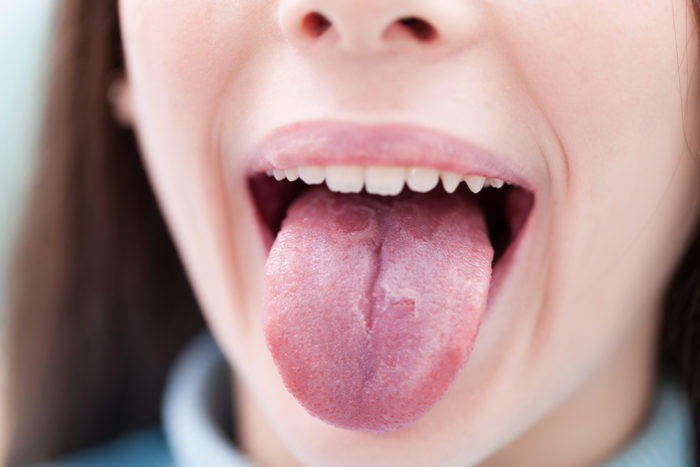 舌頭牛皮癬