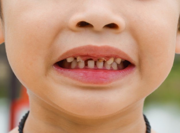 對孩子的牙齒造成傷害